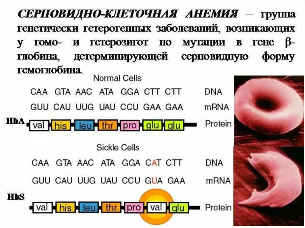 Серповидноклеточная анемия какая. Тип наследования серповидно-клеточной анемии. Серповидноклеточная анемия мутация. Серповидноклеточная анемия генная мутация. Серповидноклеточная анемия вид мутации.