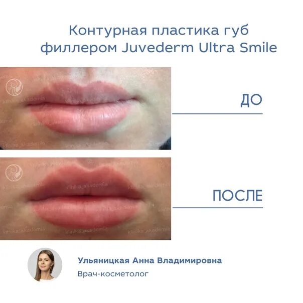 После контурной пластики губ нельзя. Контурная пластика губ фото. Juvederm Ultra smile контурная пластика. Схема контурной пластики губ. Реклама на контурную пластику губ.
