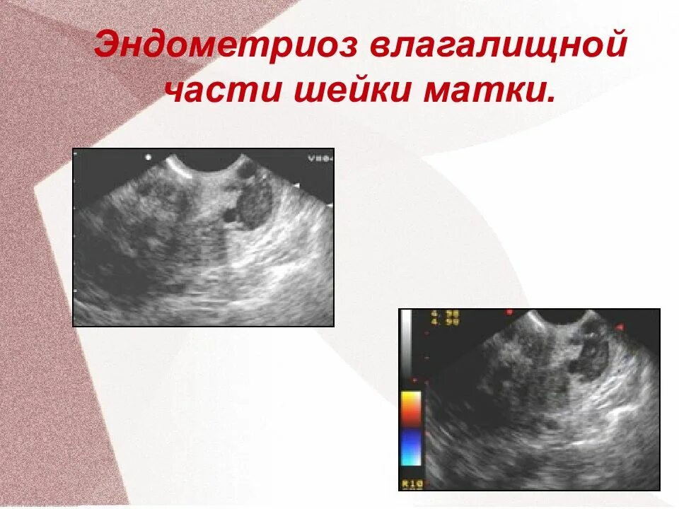 Что такое признаки внутреннего эндометриоза матки. Эндометриоз шейки матки. эндометриоз шейки матки на узи.