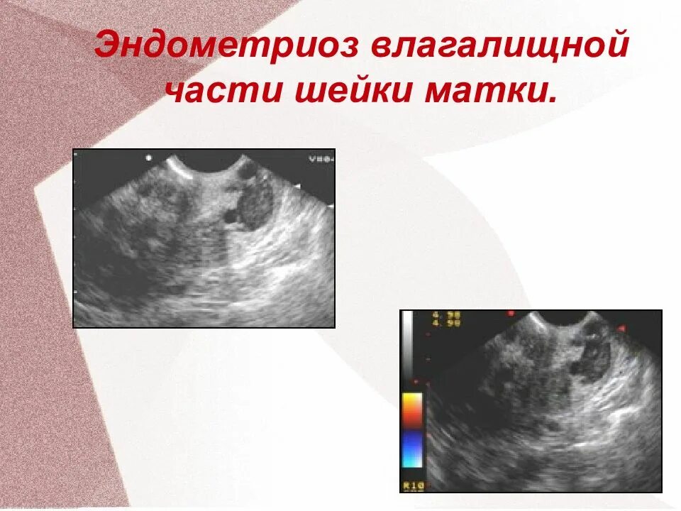 Эндометриоз шейки матки. Эндометриоз шейки матки на УЗИ. Эндометриоз видно на узи