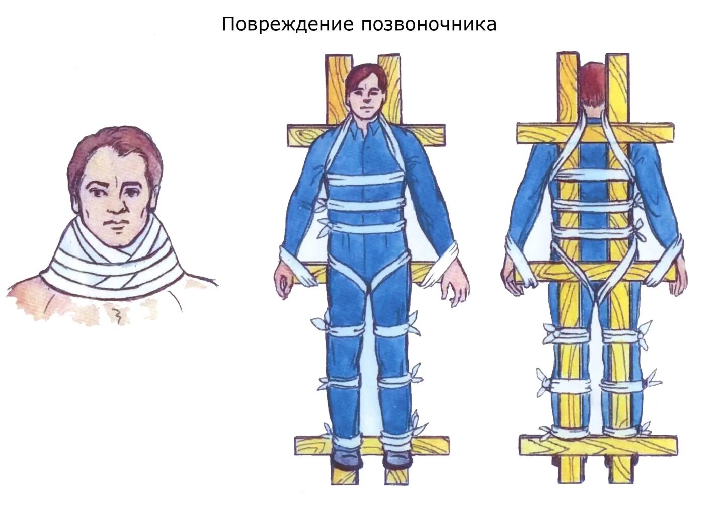 Шина при травме головы. Шина при переломе позвоночника. Наложите шину при переломе позвоночника.. Наложение шины при переломе костей таза.