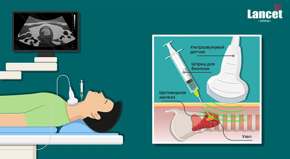 Тонкоигольная аспирационная пункционная биопсия. Пункционная биопсия щитовидной железы. Тонкоигольная аспирационная биопсия узла щитовидной железы. Прицельная тонкоигольная аспирационная биопсия.