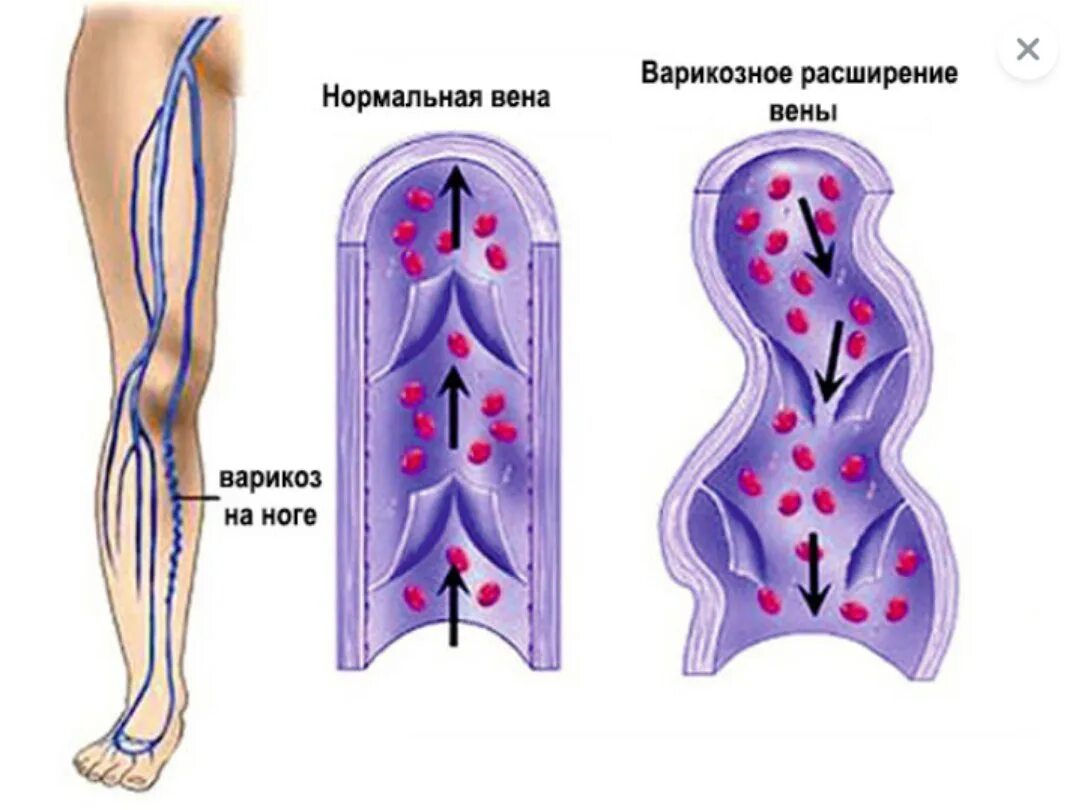Варикозное расширение массаж. Варикозное расширение влагалища. Варикозное расширение вен влагалища. Варикозно расширенные вены влагалища.