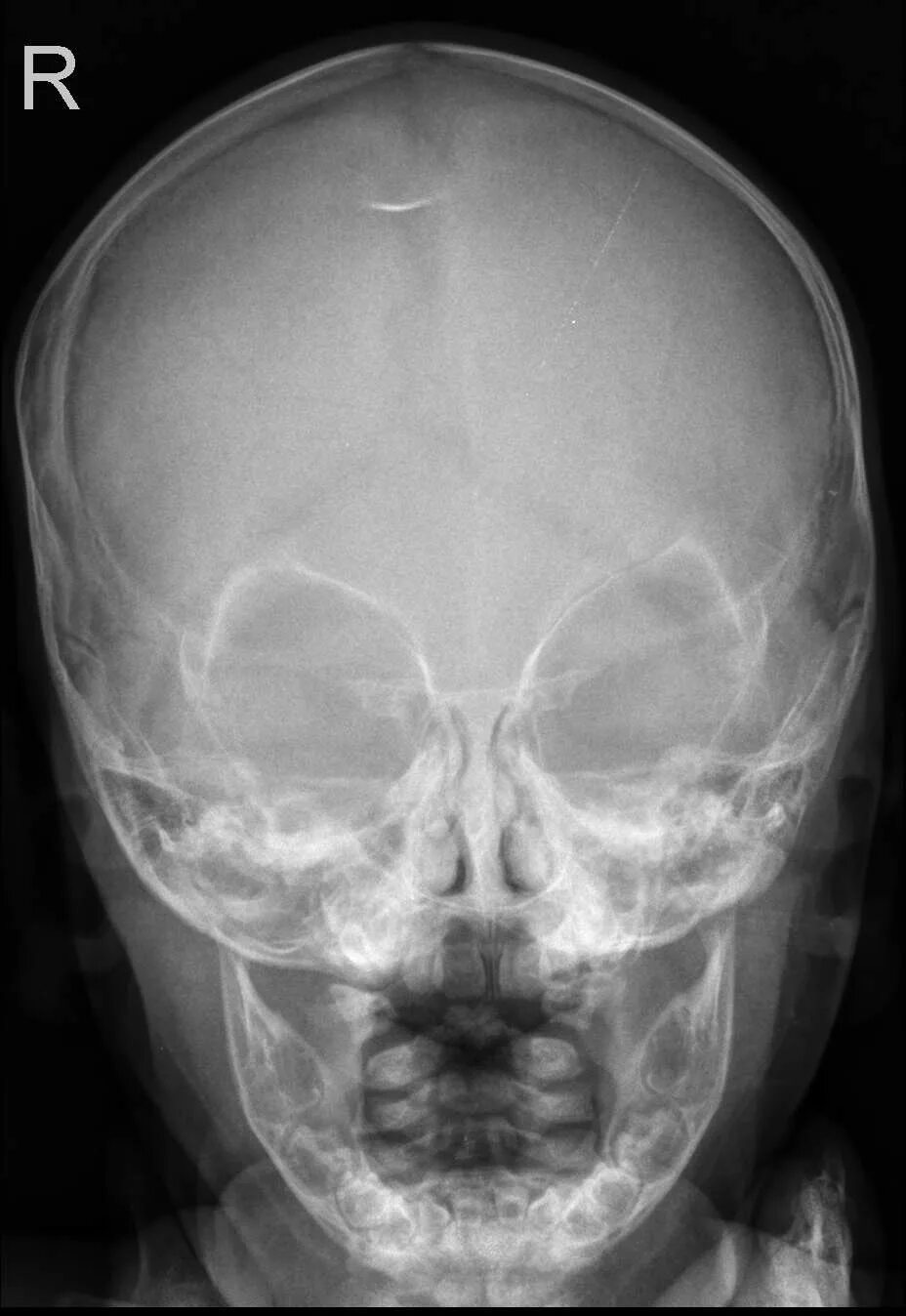 Детский череп рентген. Гиперостоз черепа рентген. Гиперостоз лобной кости рентген. Фронтальный гиперостоз лобной кости. Гиперостоз костей черепа.