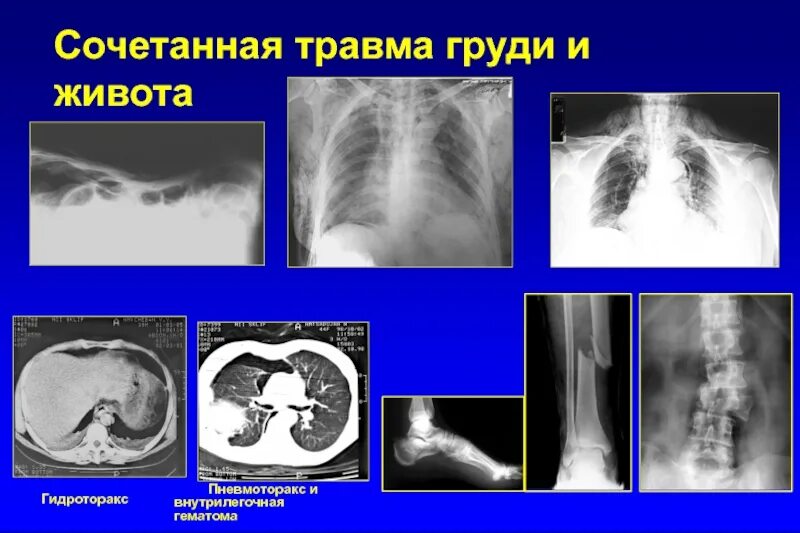 Сочетанные и комбинированные повреждения. Тяжелая сочетанная травма.