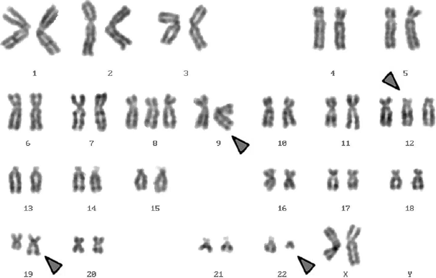 Филадельфийская хромосома кариотип. Транслокация кариотип. Синдром Клайнфельтера кариотип. Транслокация хромосом кариотип.