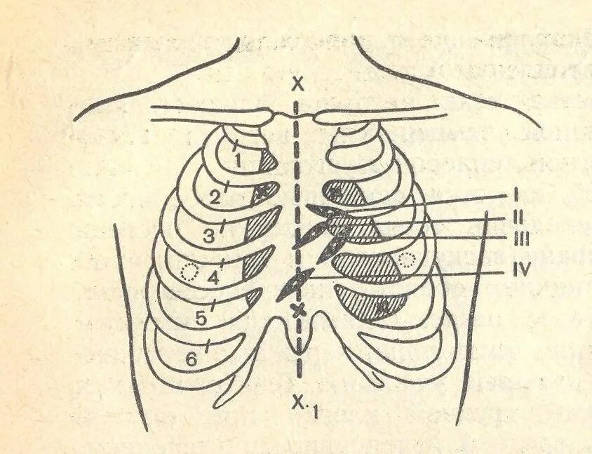 Точки аускультации грудной клетки схема. Проекция клапанов сердца на грудную клетку. Точки аускультации клапанов сердца. Точки аускультации тоны схема. Клапаны сердца на грудной клетке