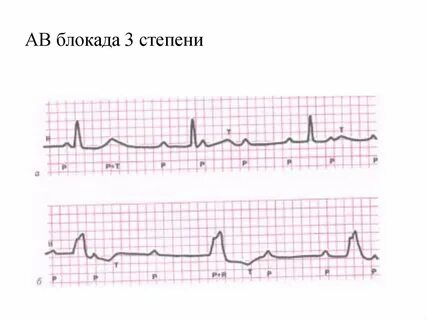 Блокада 3 степени