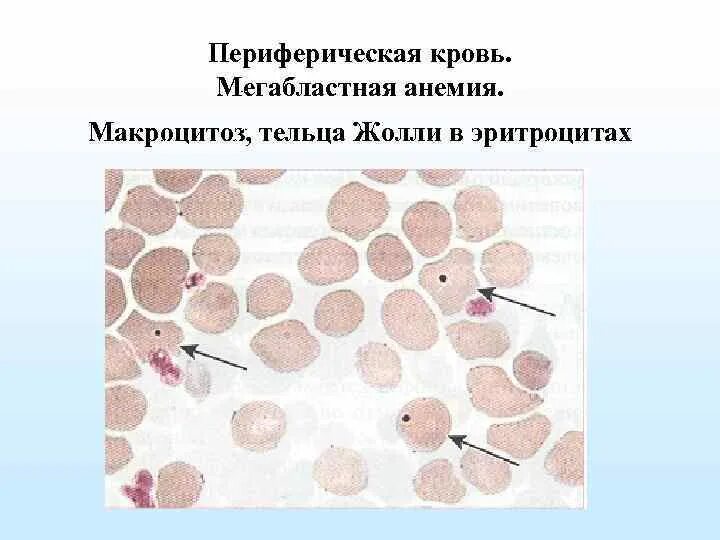 Тельце гейнца. Тельца Жолли и Кебота. Тельца Жолли и кольца Кебота. Тельца Жолли кольца Кебота анемия в12. Тельца Кебота тельца Жолли.