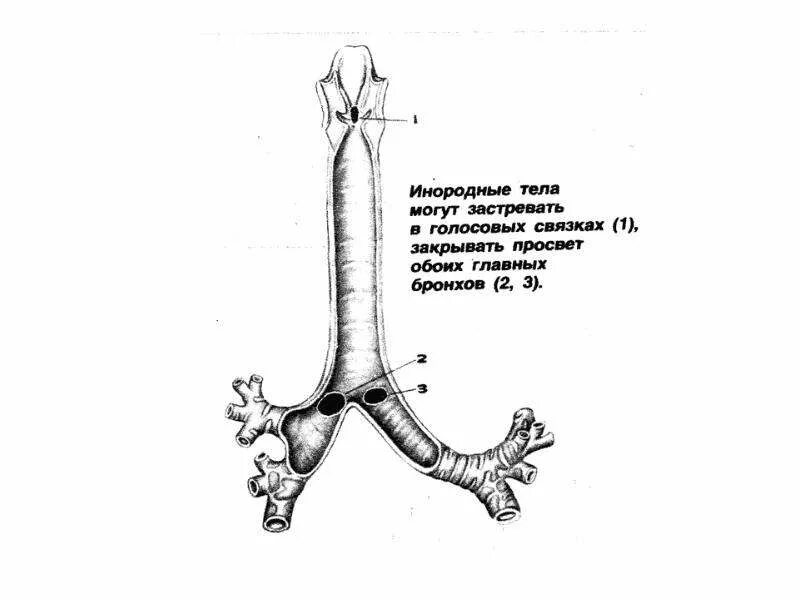 Инородные Тела Трахеи Бронхов