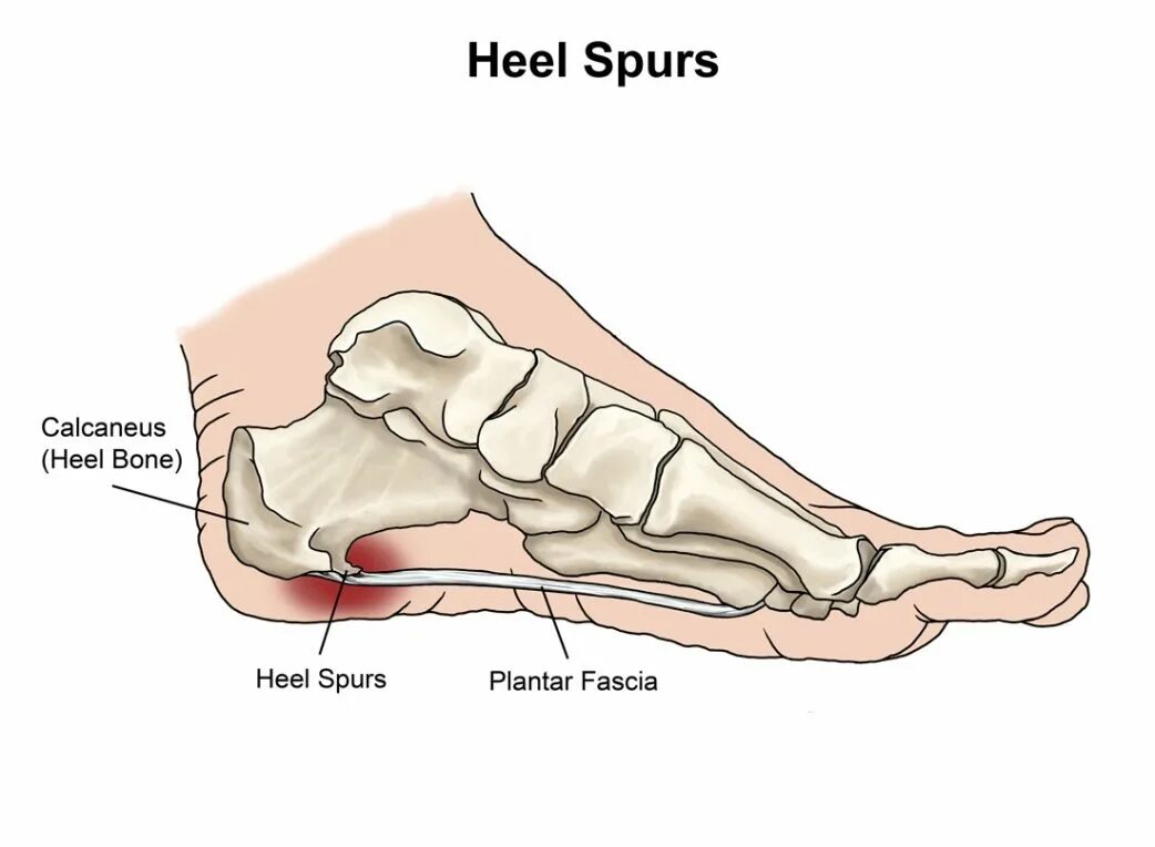 больно пяточную кость