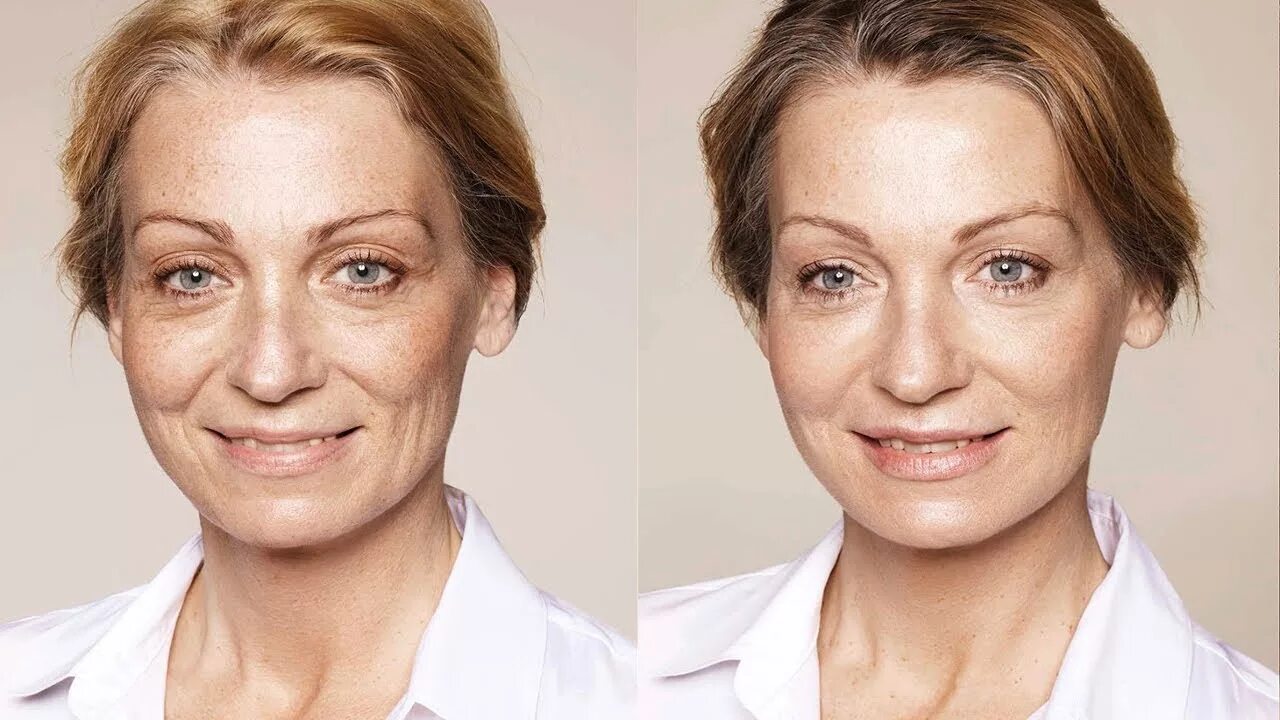 Restylane Lift (1 мл). Филлеры для лица. Омоложение лица до и после. Филеры в косметологии.