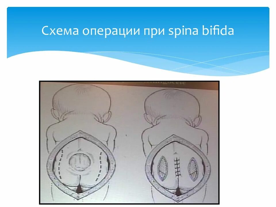 Внутриутробная хирургия плода. Spina Bifida внутриутробная операция. Внутриутробная коррекция spina Bifida. Фетальная хирургия внутриутробная хирургия.