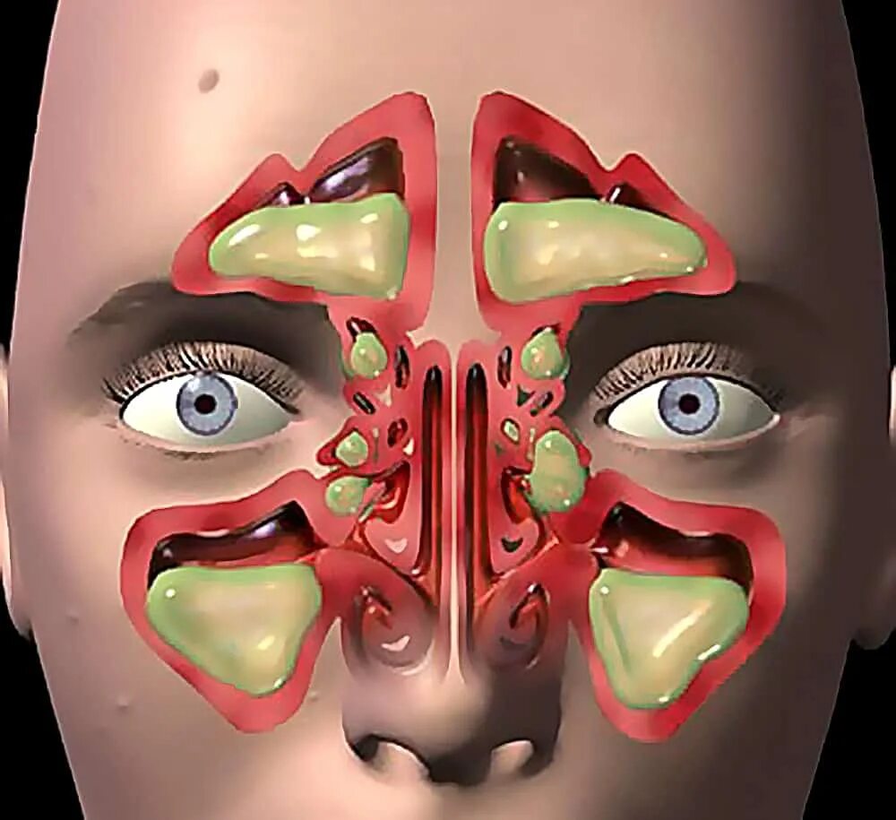 Синусит фронтит этмоидит. Гайморова фронтит синусит. Острый верхнечелюстной синусит. Синусит верхнечелюстной пазухи. Заболевания головные заболеваниях носа