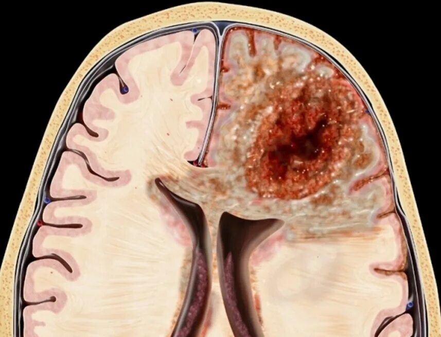 Глиобластома мозга симптомы. Глиобластома 4 степени. Глиобластома головного мозга. Онкология глиобластома. Четвертая степень злокачественности опухоли головного мозга.