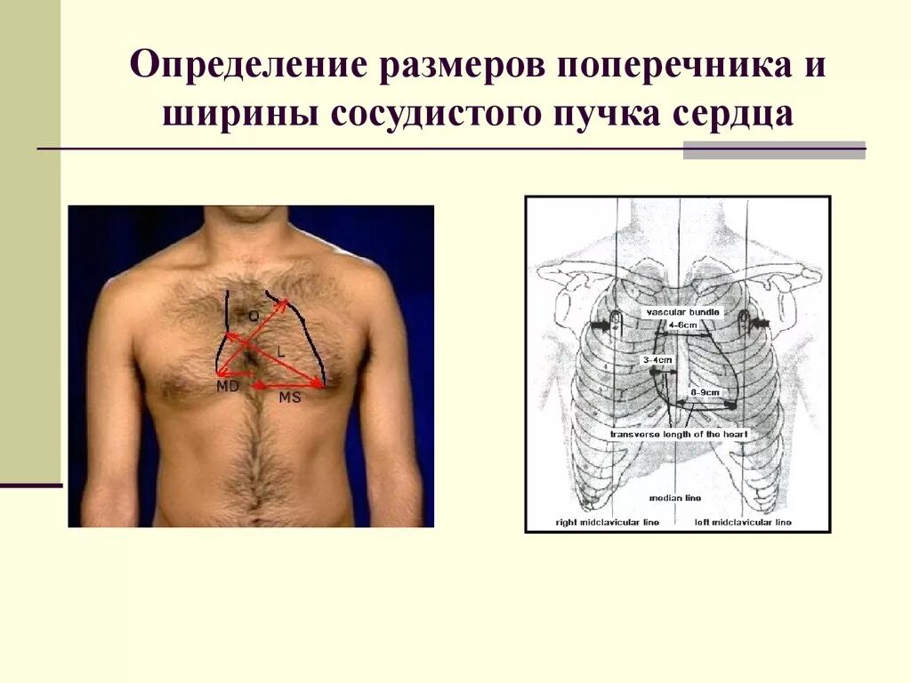 Методика определения ширины сосудистого пучка. Поперечник сердца пропедевтика. Измерение поперечника сердца и ширины сосудистого пучка. Сосудистый пучок сердца. Длинник и поперечник