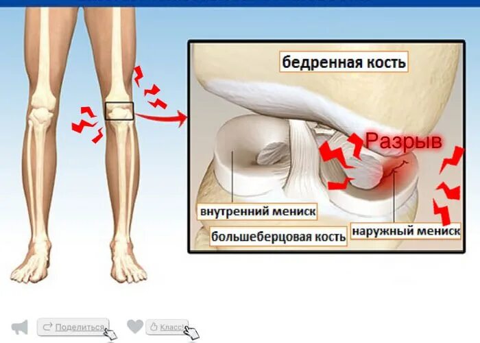 Внутренний и наружный мениск. Мениск коленного сустава симптомы. Разрыв мениска коленного симптомы. Повреждения мениска коленного сустава как лечить