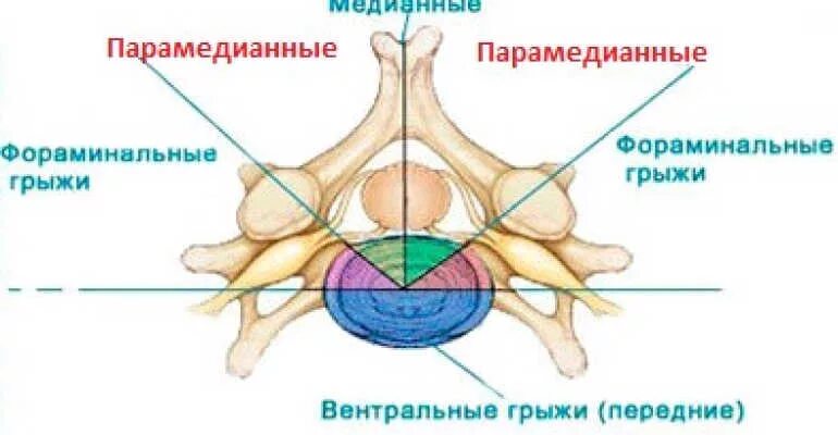 Грыжа диска l5-s1. Парамедианная грыжа диска. Парамедианная грыжа диска. Медиальная грыжа поясничного отдела. Парамедианная грыжа диска.