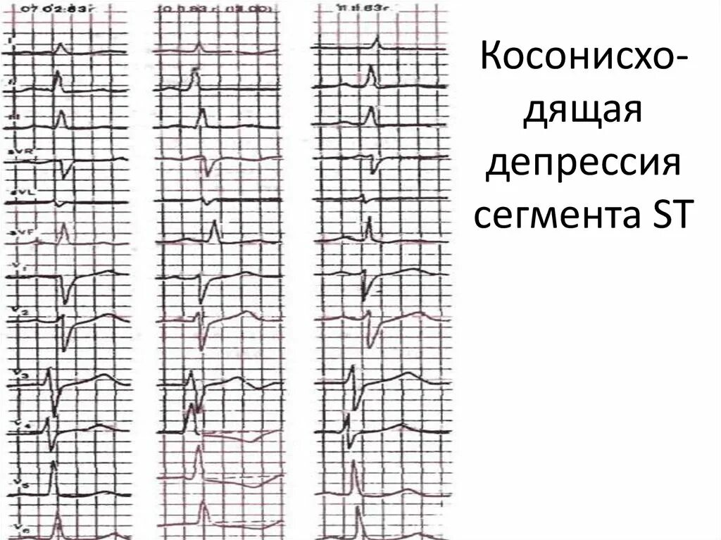 Депрессия сегмента. Реципрокная депрессия сегмента st. депрессия сегмента pr на экг. резолюция сегмента st. депрессия сегмента с с высоким тиц.