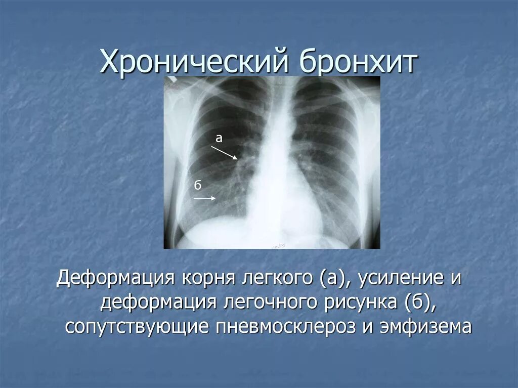 Изменения корня легкого. Рентген ОГК при хроническом бронхите. Хр бронхит рентген. Усиление деформация легкого рентген. Деформация легочного рисунка.