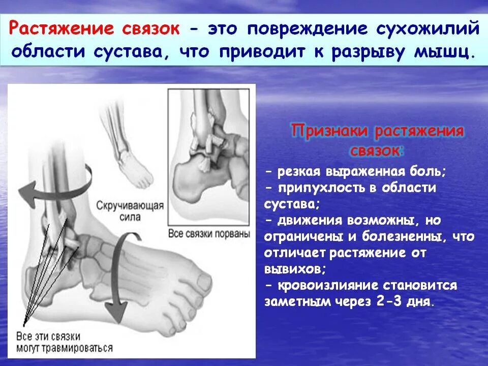 Признаки разрыва мышц. Оказание первой помощи при растяжении и связок сухожилий мышц. растяжение и разрыв связок. • растяжение, повреждение связок. причины растяжения и разрыва связок.
