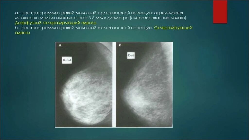 Диффузная фиброзно-кистозная мастопатия рентген. Фиброзная мастопатия маммограмма. Фиброзно-кистозная мастопатия рентген молочных желез. Диффузная мастопатия молочной железы рентген. Фиброаденоматоз bi