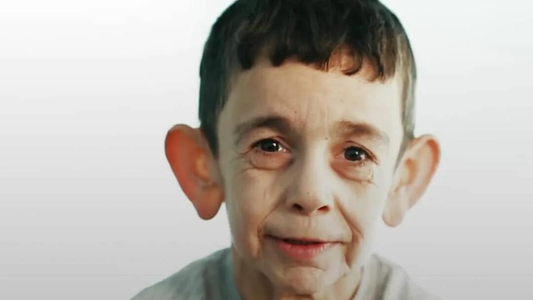 Синдром хатчинсона гилфорда. Прогерия хатчинсона-гилфорда. Синдром хатчинсона гилфорда. Синдром старого ребенка. Прогерия катя неженцева.