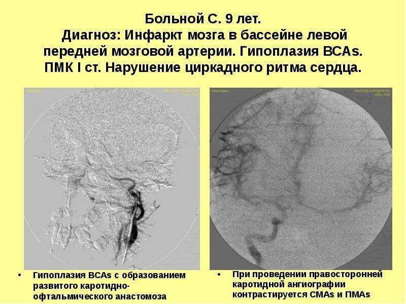 Гипоплазия мозговой артерии. Гипоплазия передних мозговых артерий. Гипоплазия левой передней мозговой артерии. Гипоплазия артерии мозга.