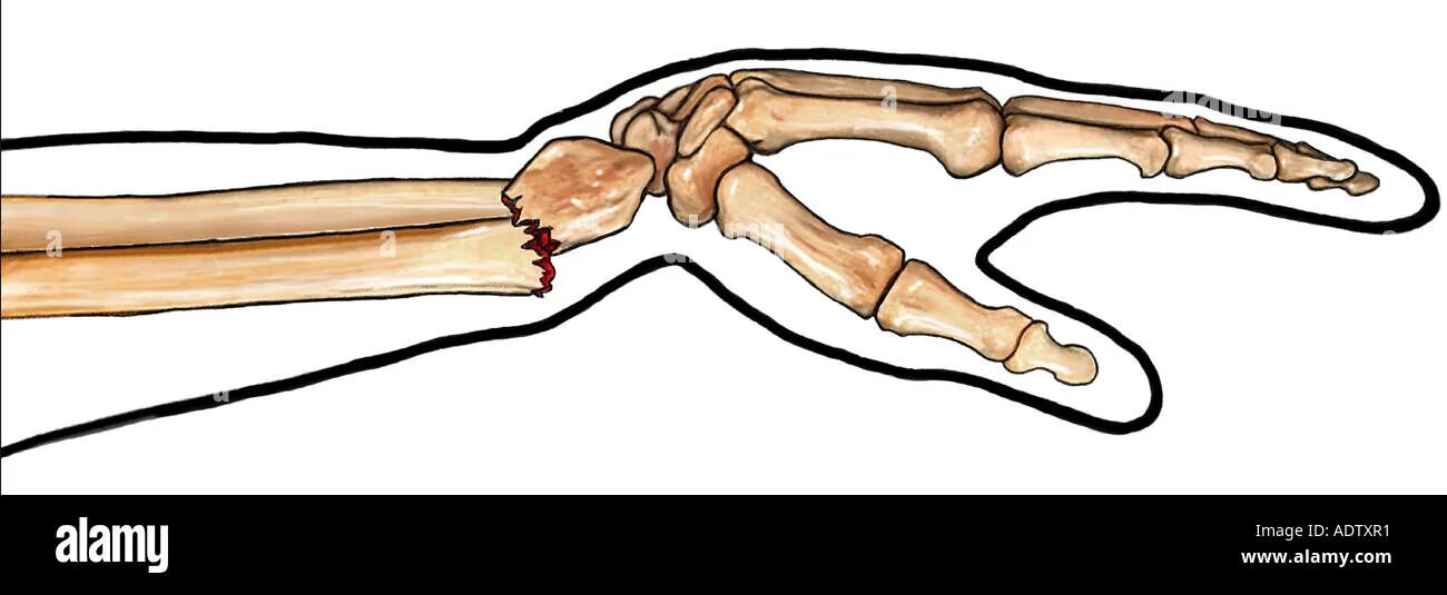 Открытый перелом кости руки. Лучевая кость на руке перелом. Перелом лучевой кости штыкообразная деформ. Открытые переломы лучевой кости.