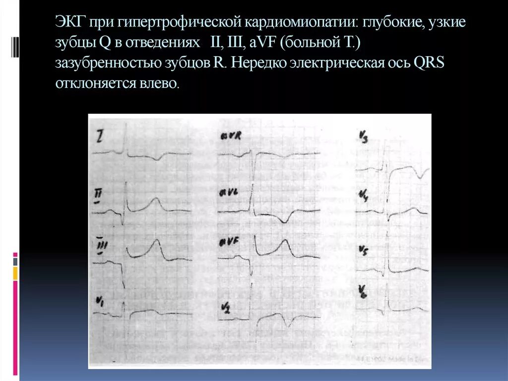 Изменение зубца q. Узкий глубокий зубец q II III AVF v5 v6. Зубец q в 3 отведении на ЭКГ И AVF. Патологические зубцы q в II, III, AVF.. Зубец q во 2-3 отведения и AVF.