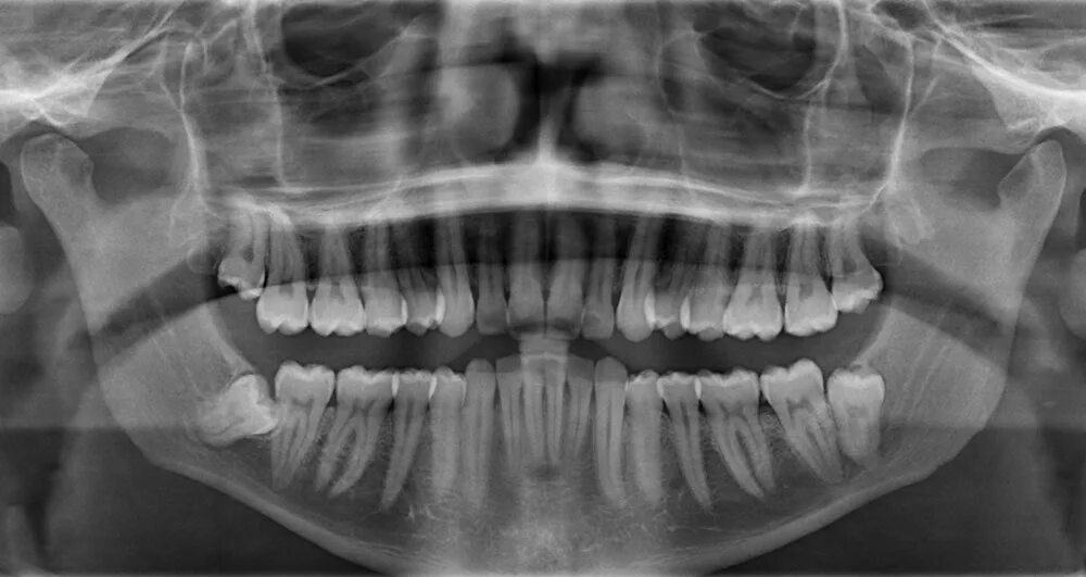 Снимок зубов видное. Ортопантомограмма челюсти. Ортопантомограмма пародонтит.