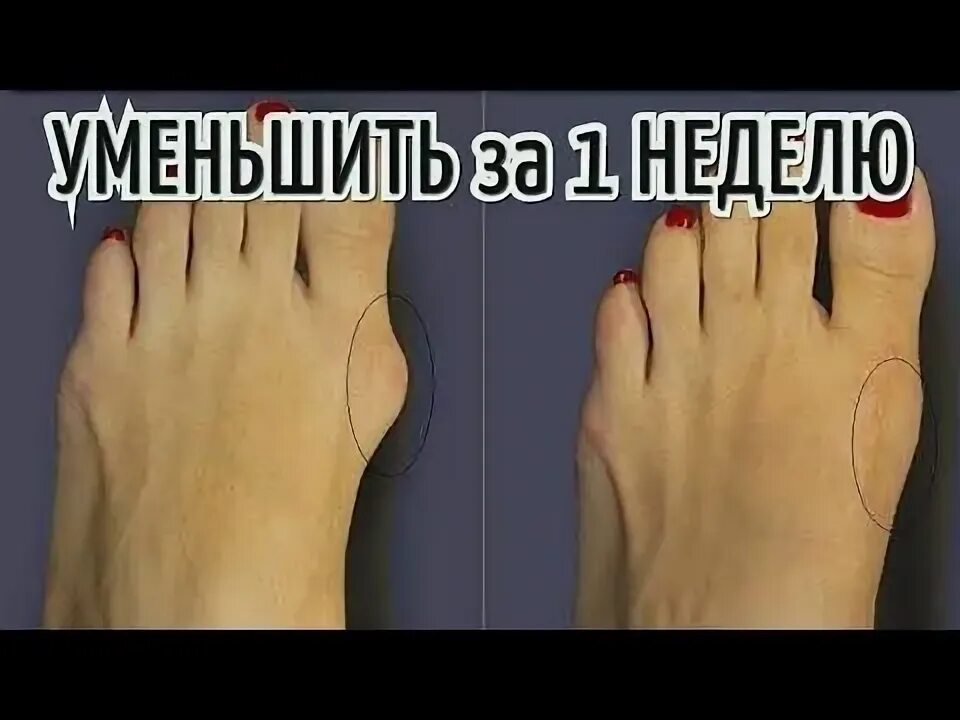 Как вылечить у большого пальца косточку. Выпирающая косточка на ноге. косточка на ноге у большого пальца. выпирает косточка на ноге возле большого пальца. выпирает кость на большом пальце ноги.