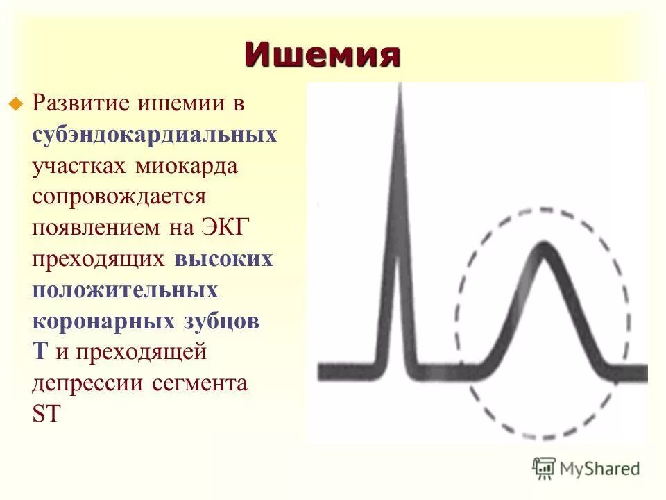 Критерии ишемии