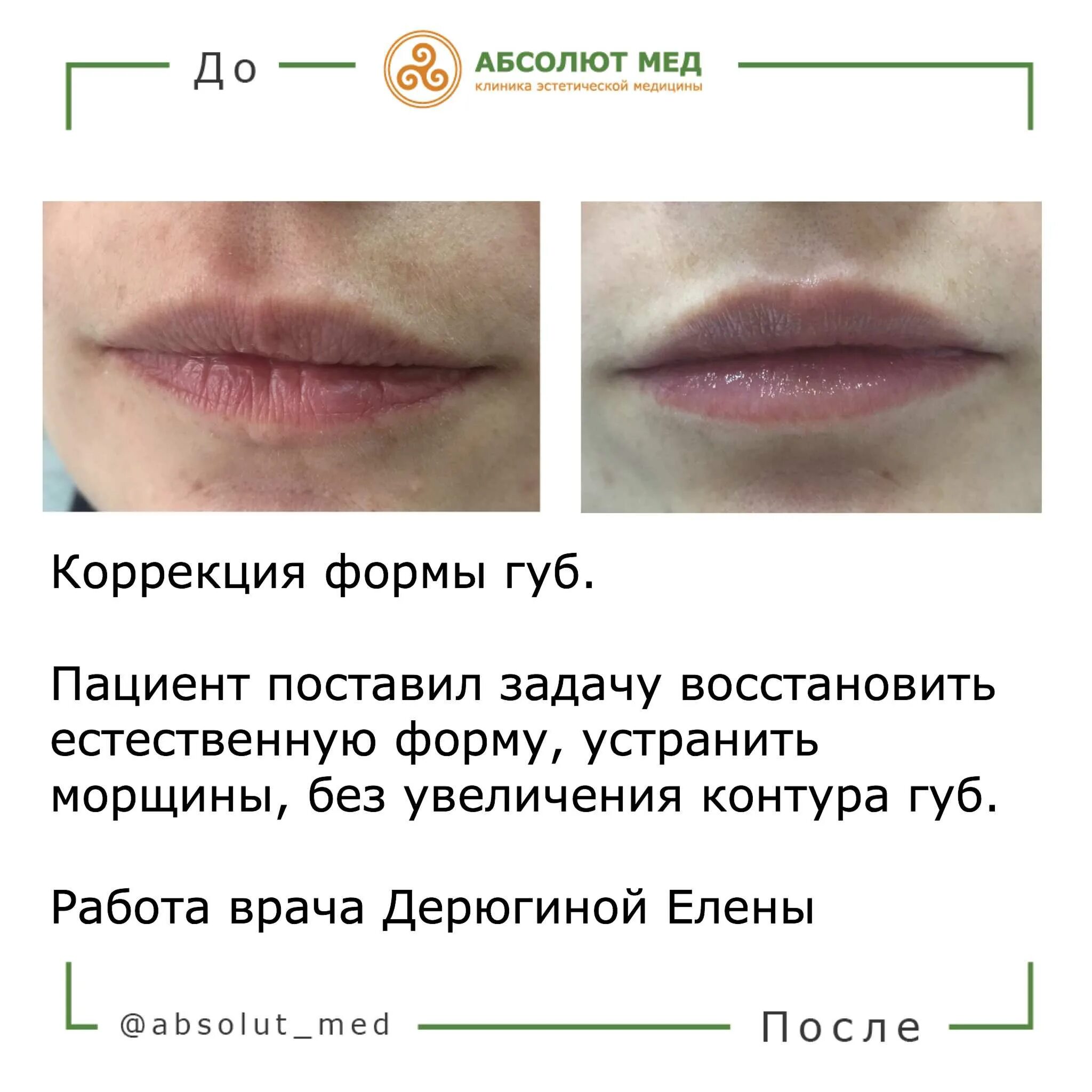 Формы губ для увеличения гиалуроновой кислотой. Схема увеличения губ гиалуроновой. Рекомендации после увеличения губ. После контурной пластики губ нельзя