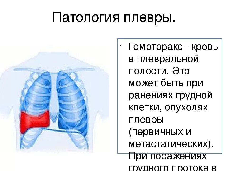 Скопление крови в грудной полости. Пневмоторакс и гемоторакс.