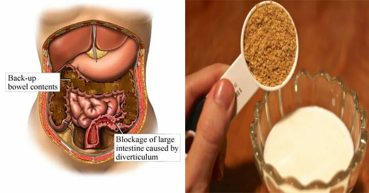Как прочистить кишечник дома. Каловые камни в кишечнике.