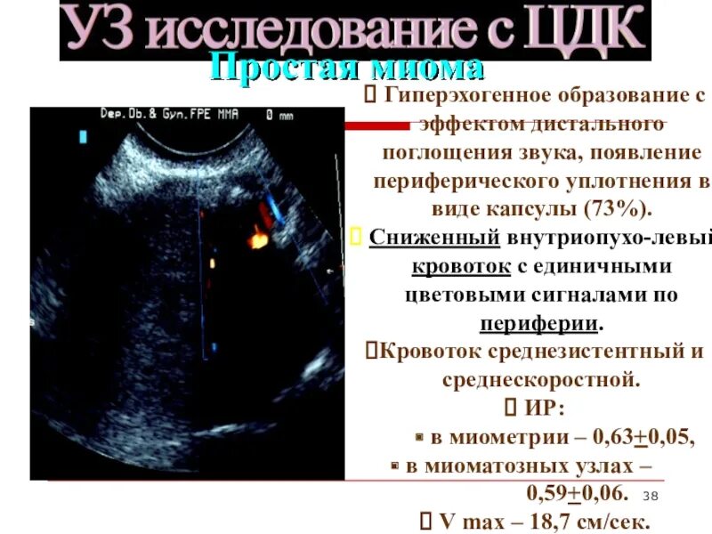 Аваскулярное образование в печени. При ЦДК единичные локусы кровотока по периферии. Образование яичника на УЗИ. Периферический кровоток на УЗИ.