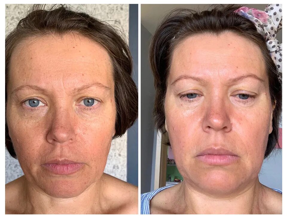 тейпирование лица от брылей до и после. пластыри для лица от морщин до и после. тейпы до и после. тейпирование лица до и после фото. тейпирование лица результаты.