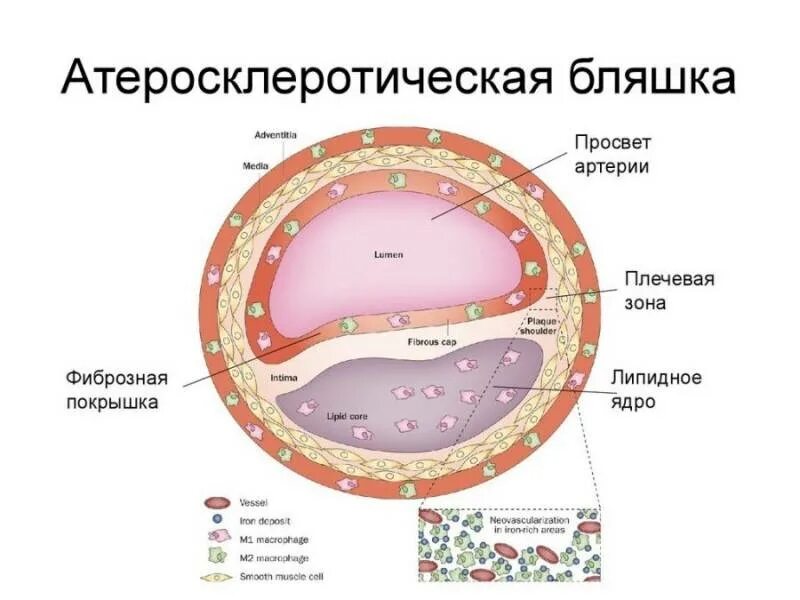 Что такое атеросклеротические бляшки. Основные компоненты фиброзной атеросклеротической бляшки. основной компонент фиброзной атеросклеротической бляшки. строение покрышки атеросклеротической бляшки. атеросклероз строение бляшки.