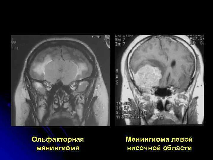 Менингеальная оболочка мозга. Менингиома лобной доли мрт. Менингиома крыла клиновидной кости. Менингиома в голове что это такое простыми. Менингиома в голове что это такое простыми.
