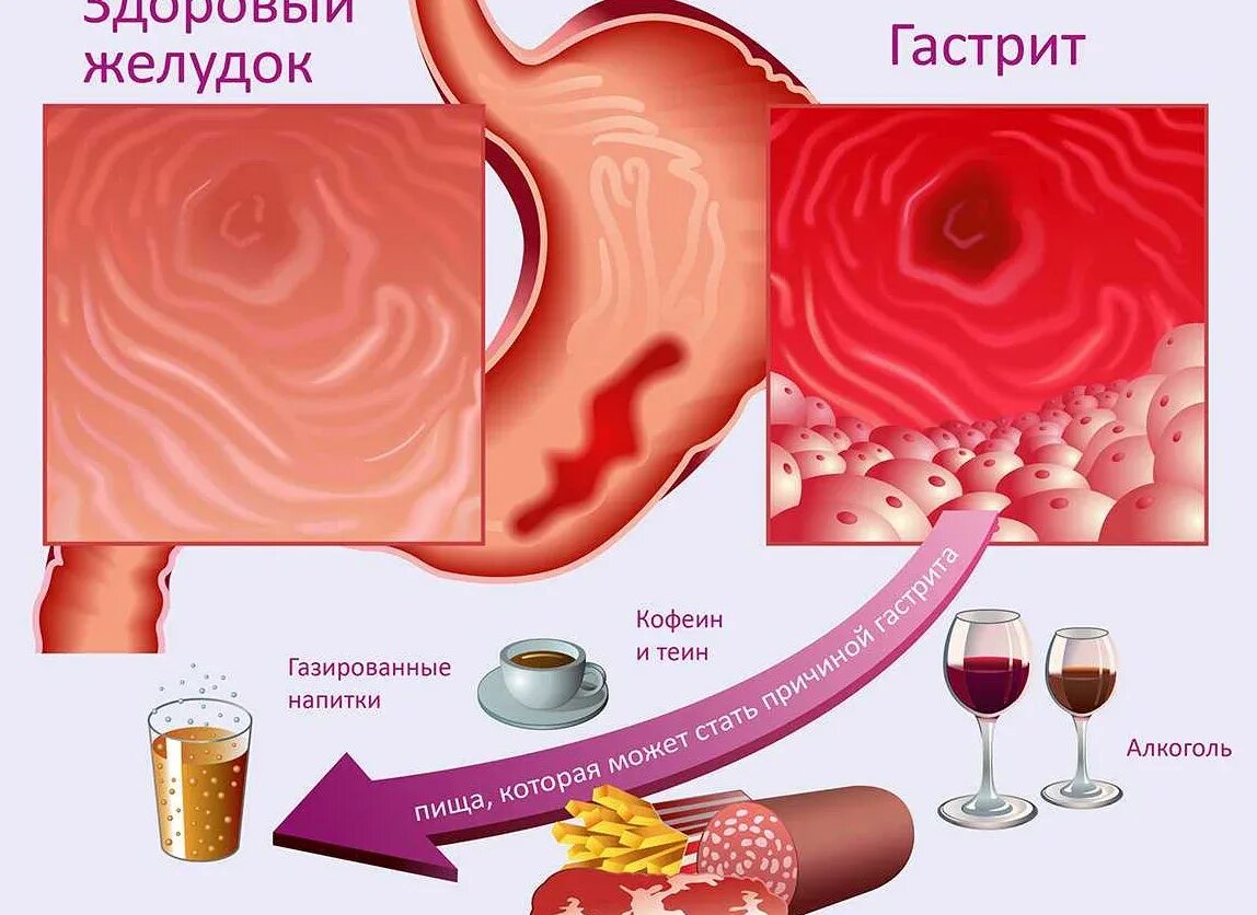 Сколько лечится гастрит