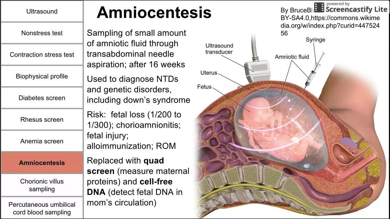 Screening and screening media. Prenatal screening. screening test pregnancy.