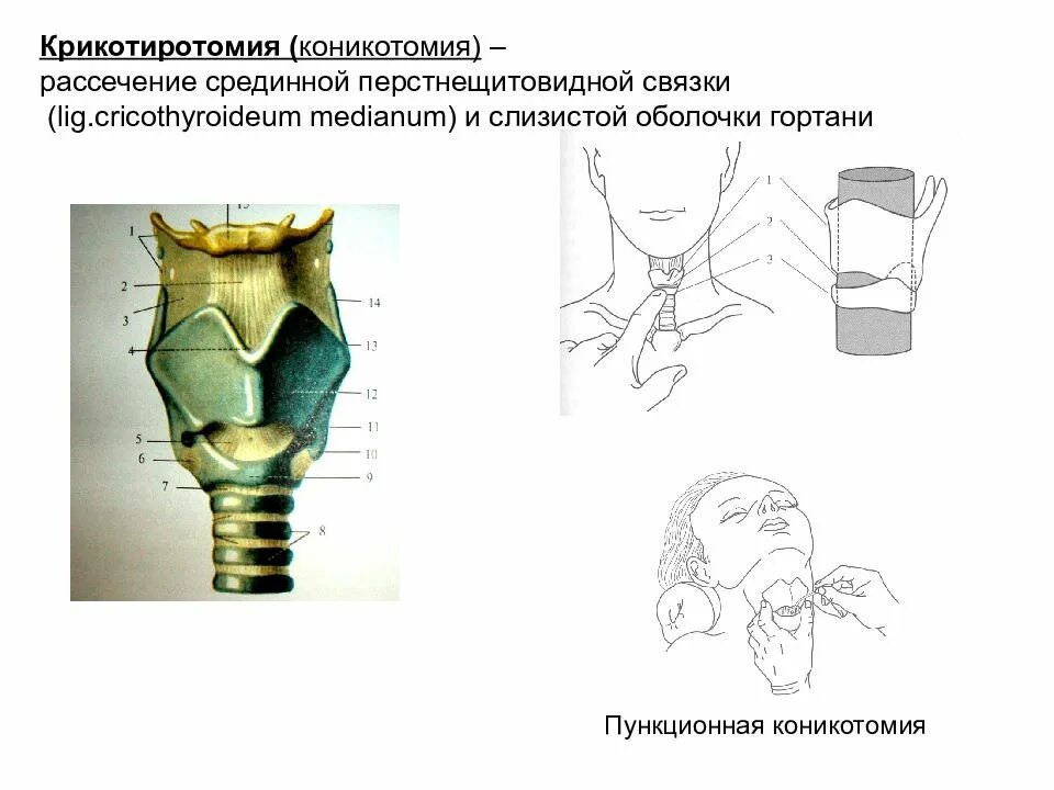 Хирургические заболевания шеи. Срединная перстнещитовидная связка. Пункционная коникотомия. Перстнещитовидная связка анатомия. Перстне щитовидная свзяка.