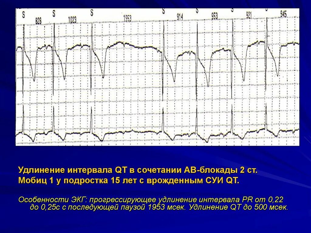 Удлиненное qt на экг. Синдром удлиненного qt на ЭКГ. Синдром удлинения qt на ЭКГ. Синдром удлинения интервала qt ЭКГ. Норма корригированного qt на ЭКГ.