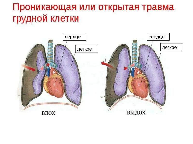 Коллапс одного легкого что это. Травмы грудной клетки пневмоторакс. Одно легкое закрыто. Дисковидный ателектаз на рентгене легких. Одно легкое закрыто.