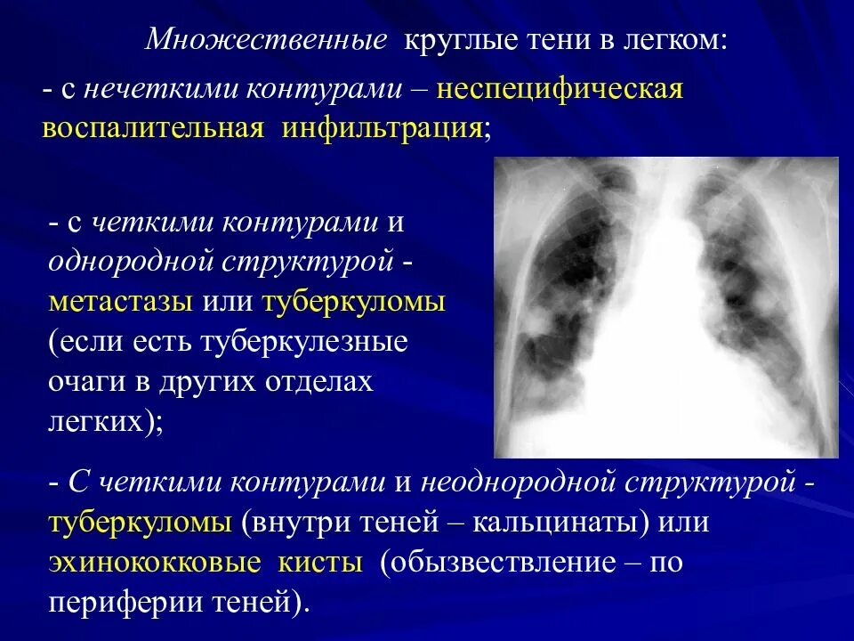 Очаги в легких с нечеткими контурами. Обызвествление легких. Тени кальцинатов в легких. Кальцинаты в лимфоузлах