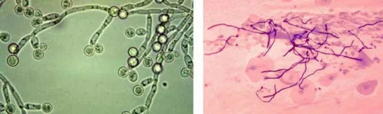 Кандидоз псевдомицелий. Псевдомицелий гриба рода Candida. Грибы кандида микроскопия. Мазок кандида псевдомицелий.