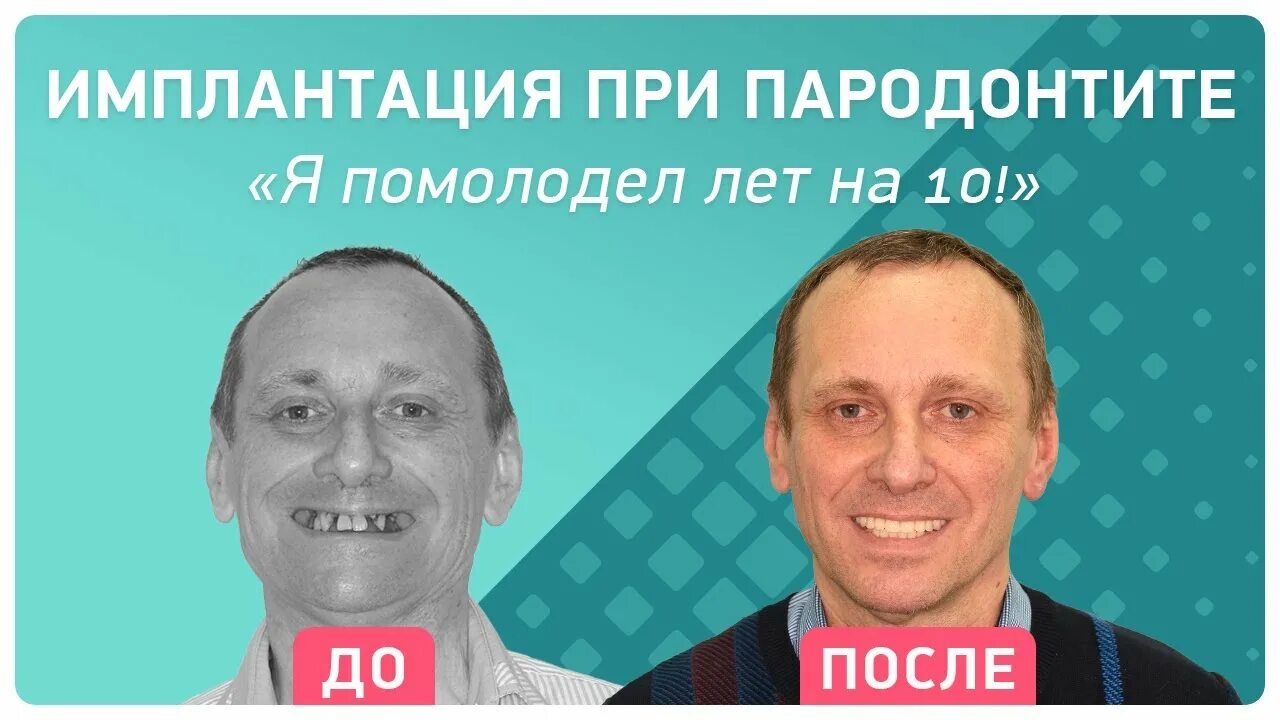 Имплантация все на 4 отзывы пациентов. Зубы на имплантах отзывы реальных пациентов. Зубы на имплантах отзывы реальных пациентов. Мост на имплантах на 4 зуба. Зубы на имплантах отзывы реальных пациентов.