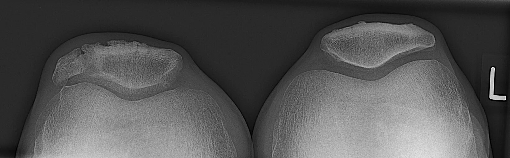 Латерализация надколенника. Остеохондропатия надколенника. Остеохондропатия надколенника рентген. Бипартита надколенника.