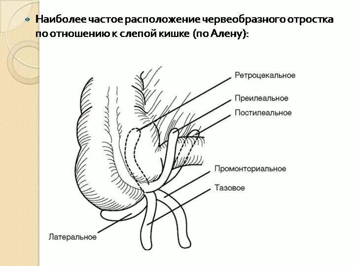 Червеобразный отросток анатомия расположение. Варианты положения червеобразного отростка. Атипичные положения червеобразного отростка. Атипичное положение червеобразного отростка.